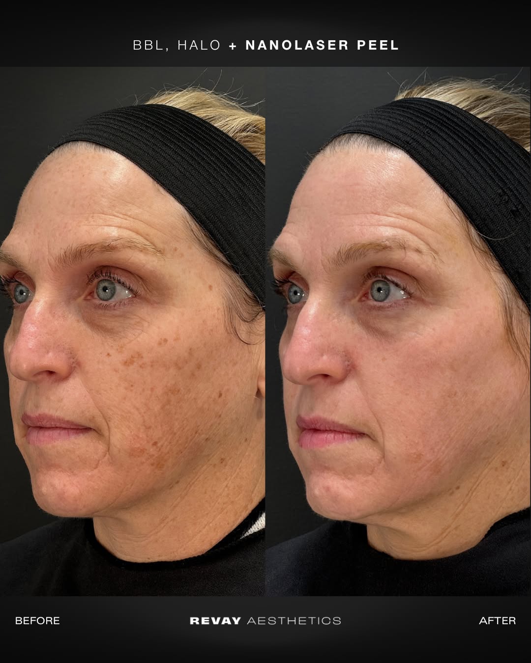 Vitamin B12 Injection | Revay Aesthetics