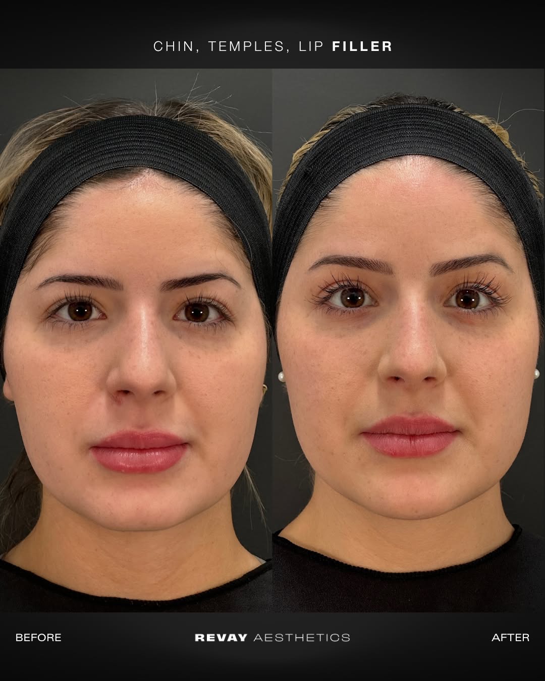 b12 injection before and after Vitamin | Revay Aesthetics Size:1000 mcg/ml - 10 ml x 2 AOD9604 | 2mg x Metabolic Research