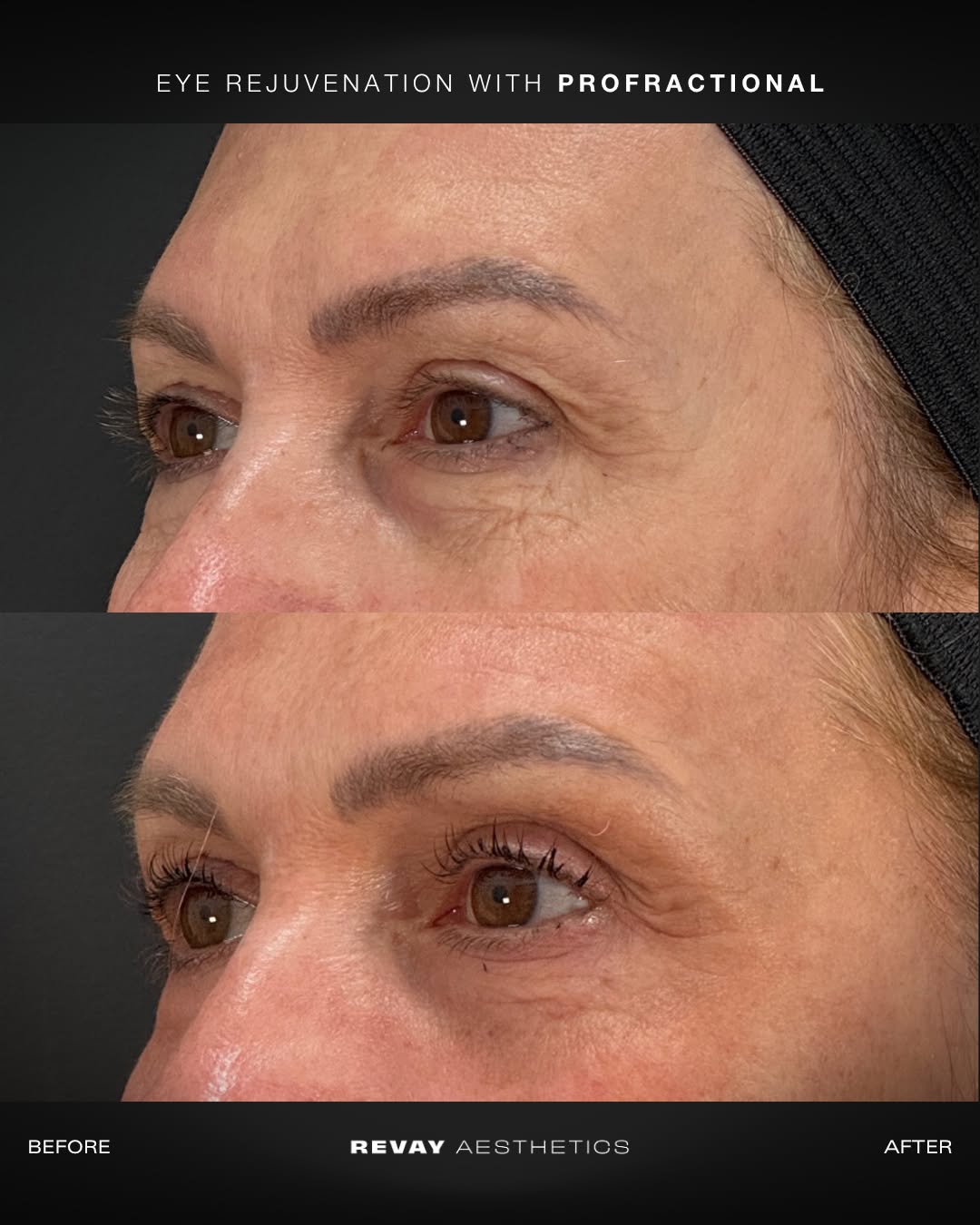 b12 inj injection dark under eyes PRP vs. Eye Filler: Revitalizing Your Look Under Eye Fillers - Before